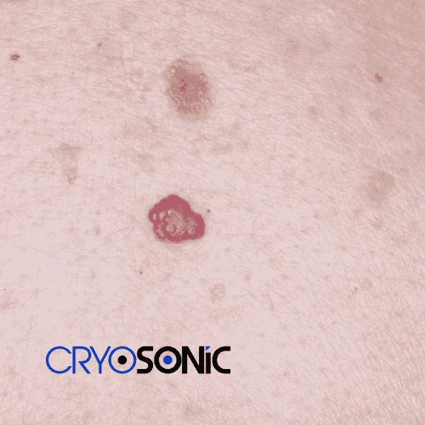 Looking for pain free cherry angioma removal treatment Cirencester? Call our team today! Cirencester