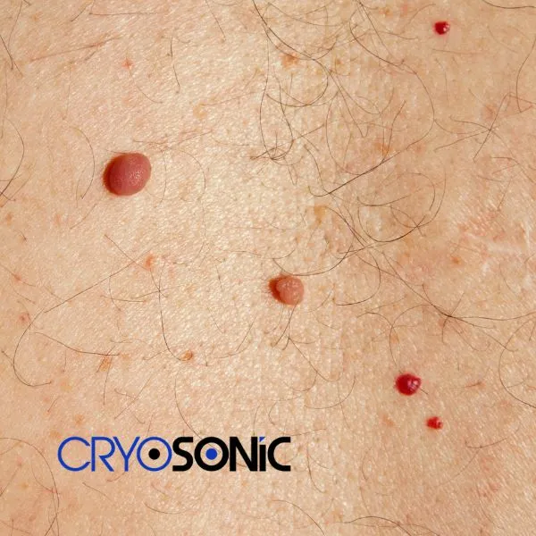get cherry angioma removal treatment today! Cirencester