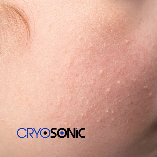 Are you looking for milia removal treatment? Contact our team today Cirencester