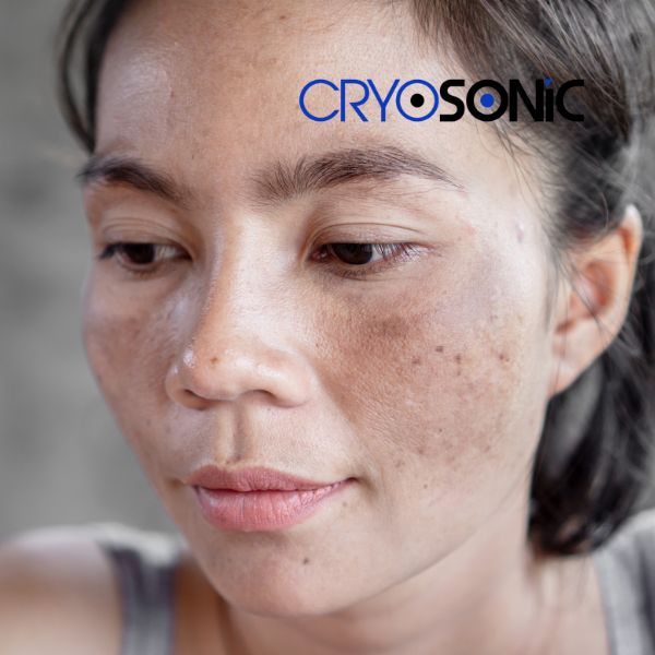 Ready to start age spots removal? Contact our team today in Cirencester