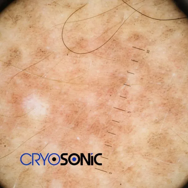 Speak to our team today about sun damaged skin treatment today in Cirencester