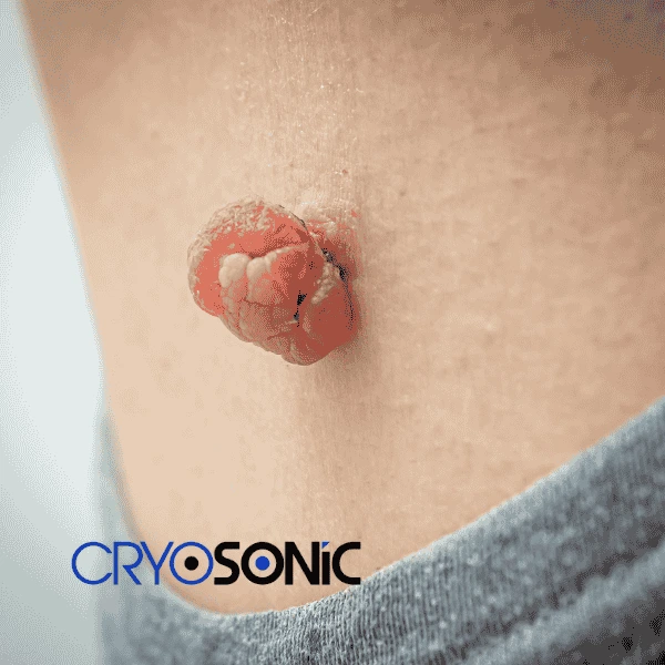 Book your skin tags removal Cirencester from comfort of your own home! Cirencester