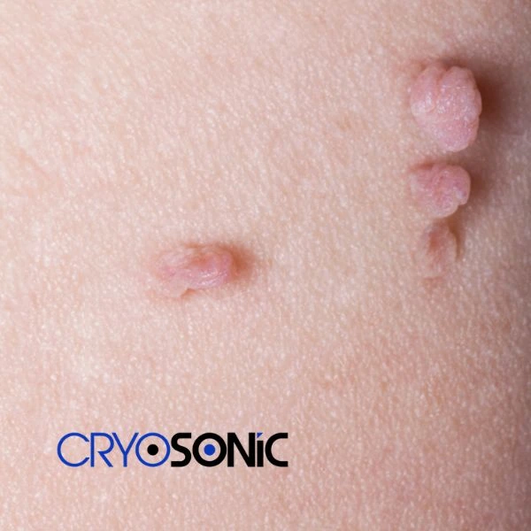 Are you looking for fast effect skin tag removal Cirencester? Book in NOW! Cirencester